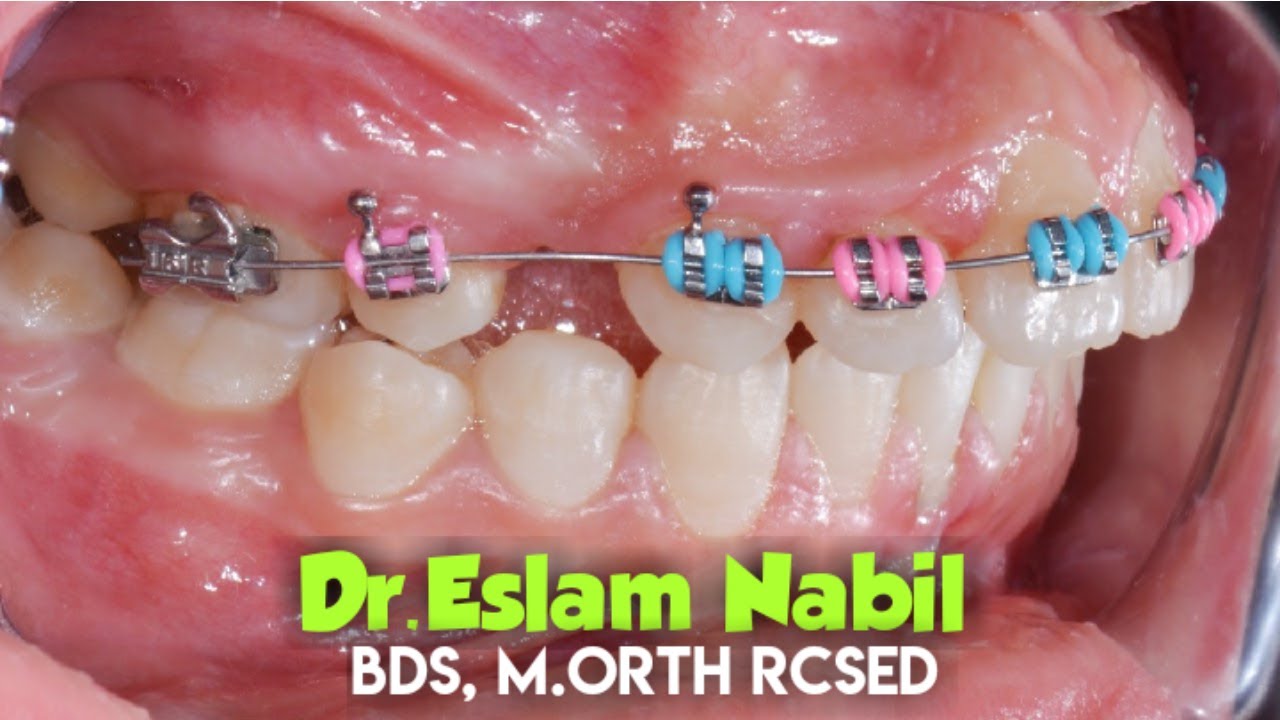 Orthodontic treatment - Braces on - Upper arch first for class 2 تقويم الأسنان فك واحد أولا