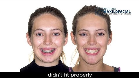 Jaw surgery Case# 112: Ana -Class II, Open bite