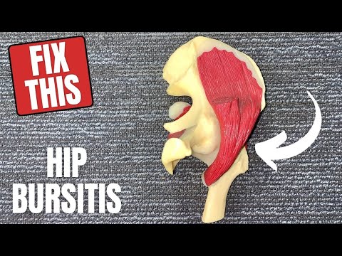 Hip Trochanteric Bursitis