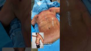 Un corps sculpté, une silhouette assumée La combinaison Lipo HD + Quantum RF 🔝