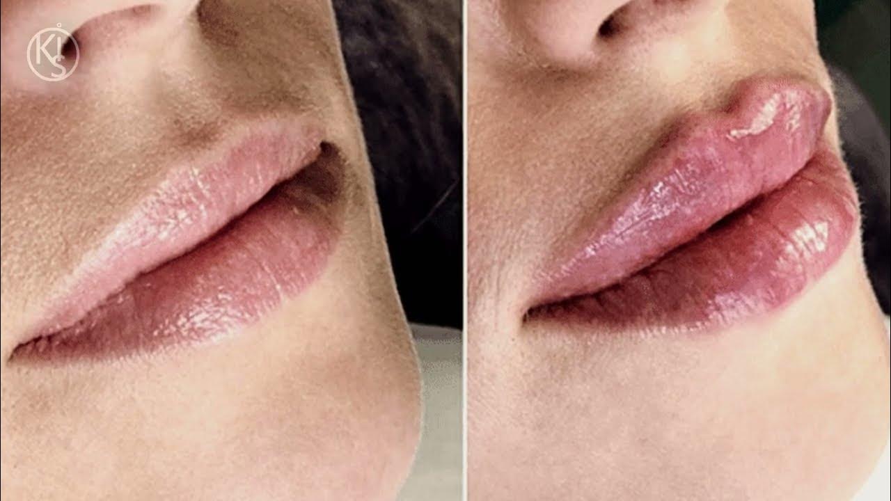 Губы после 1 ml гиалуроновой кислотой. Губы зажившие аугментация 0,5 мл. Тонкие губы гиалуроновой кислотой. Накачивание губ гиалуроновой кислотой 1 мл. Губы накаченные гиалуроновой кислотой 1 мл.