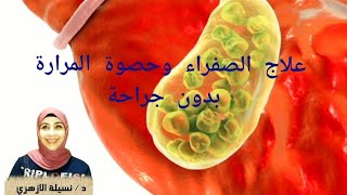 علاج حصوة المرارة الحق نفسك قبل التدخل الجراحي وصفة سهلة