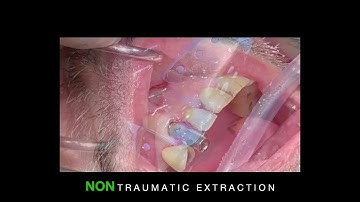 Atraumatic extraction using the Benex System