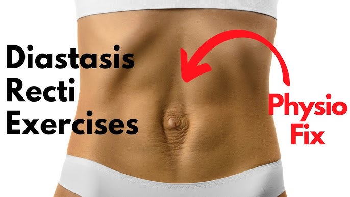 Diastasis Recti at the Belly Button 