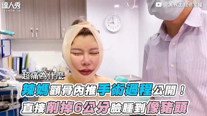 【辣妈颧骨内推手术过程公开！直接削掉6公分脸肿到像猪头】｜ @爱美教主Cherry Queen - 天天要闻