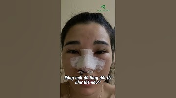 Nâng mũi cấu trúc sau 1 tháng | Bác sĩ Trọng #shots #bacsitrong #shotrs