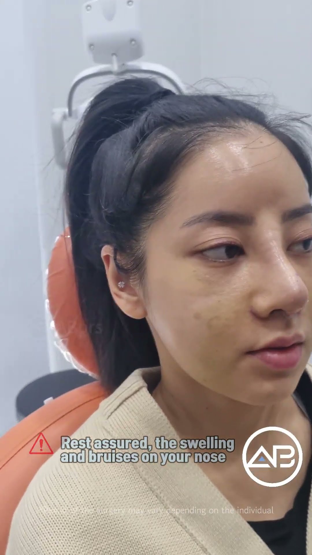 [Plastic Surgery in Korea] Revision Rhinoplasty #abplasticsurgery