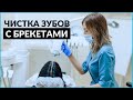 Гигиена брекет-системы. Профессиональная чистка зубов