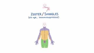 VZV - Clinical Presentation of Chicken Pox and Shingles