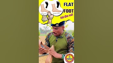 Army Medical Test | How to cure flat foot? SSC GD Medical #flatfoot #armymedical #sscgdmedical