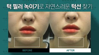 울퉁불퉁 턱 필러 녹이기❗제발 이 영상 보고 녹이세요....!!!!😮