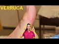 Quick  effective verruca removal advanced treatments explained  miss foot fixer