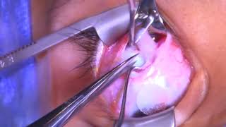 Superior Oblique Tendon Tuck And Inferior Oblique Recession Dr Maury A Marmor