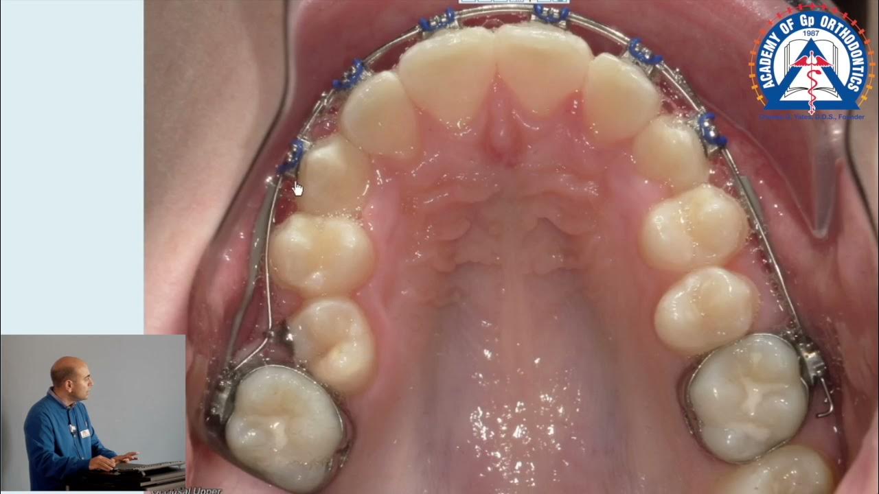 Monday Tip How to Piggyback SS and NiTi wires in Stage 1 YouTube
