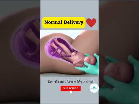 Normal Child Delivery | Baby Birth Shorts Youtubeshorts Viral