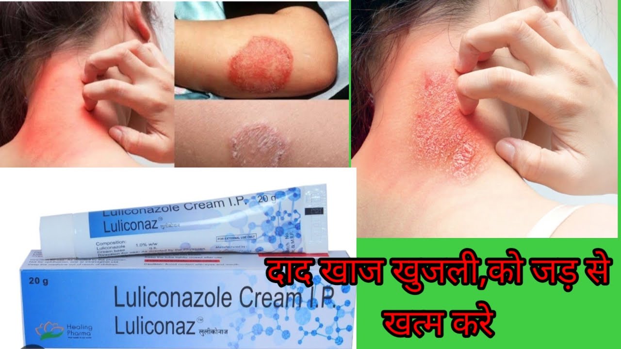 Luliconazol cream use, side effects, doses दाद खाज और खुजली का क्रीम। हिंदी में। Luliconaz cream 