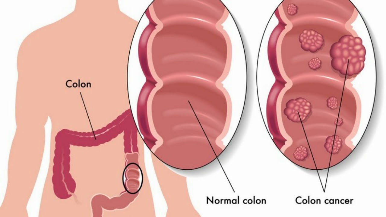 link between prostate and colon cancer