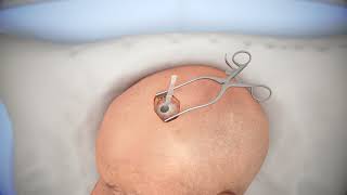 Ventriculostomy Brain Surgery - 3d animation