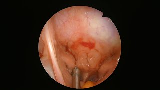 Transoral endoscopic adenoidectomy with microdebrider