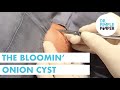 The Bloomin' Onion Cyst