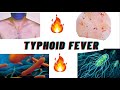 Typhoid fever - signs and symptoms causes & diagnosis