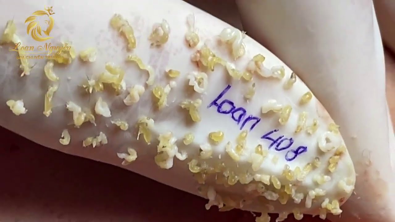 Blackheads extraction (408) | Loan Nguyen - YouTube