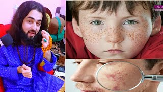 Chehra dag upay चेहरे के पिंपल्स & दाग धब्बे Pimples & Acne दूर करने का घरेलू उपाय, Avatar ZarifBaba