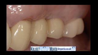 Dental Implant restored with 3D Planning and without Flap. by Dr Kuljeet Singh Mehta-Periodontist 1,275 views 1 year ago 5 minutes, 50 seconds