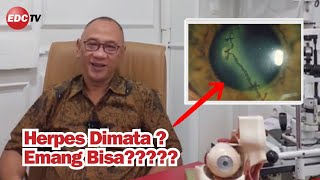 Apakah mata bisa Herpes??
