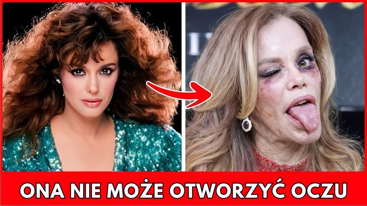 Nieudane Operacje Plastyczne Gwiazd — Szokujące Metamorfozy, Które Poszły Za Daleko