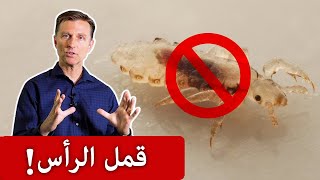 أفضل علاج منزلي لقمل الرأس!