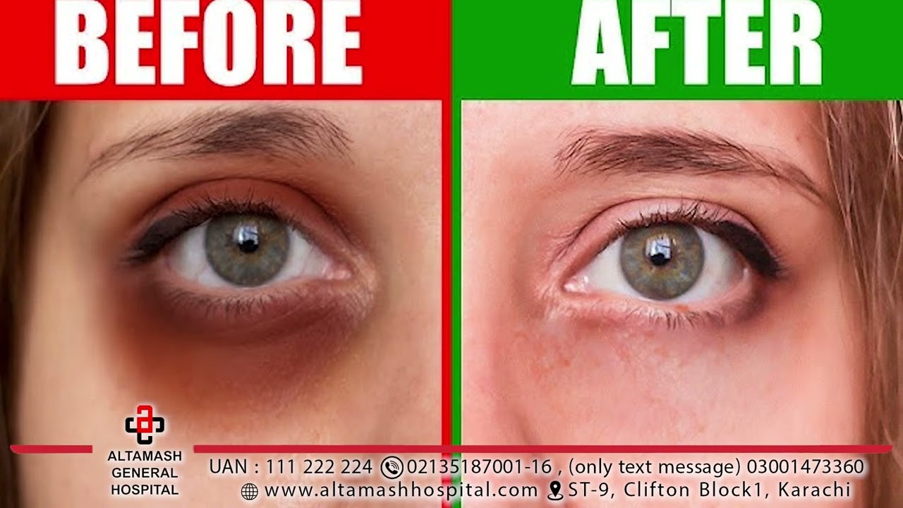 DARK CIRCLES AROUND EYES AND SKIN PIGMENTATION