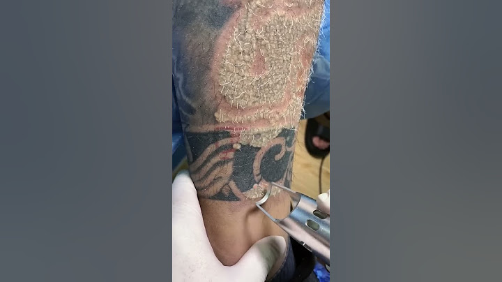 SCAR FREE TATTOO REMOVAL ep5 #short