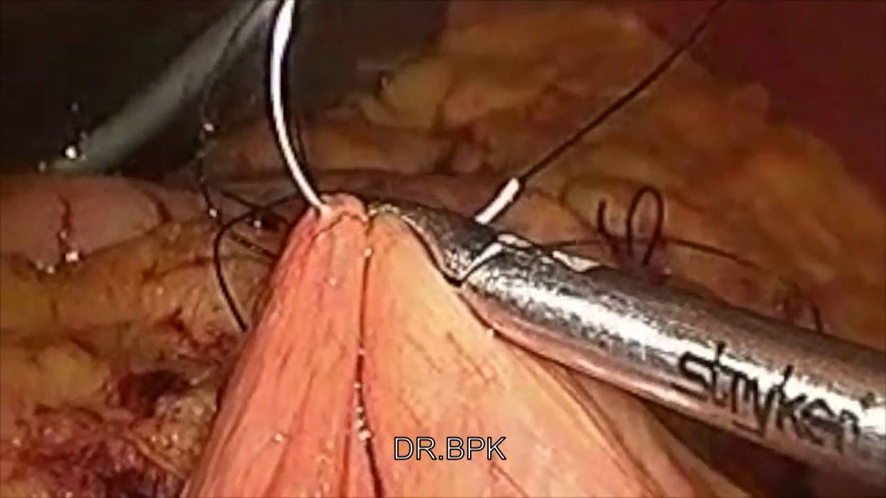 Laparoscopic Triple Bypass Youtube