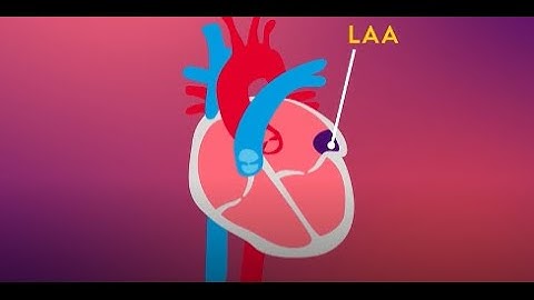 Learn About Atrial Fibrillation (AFib) and Ischemic Stroke Prevention with the LAAO Procedure