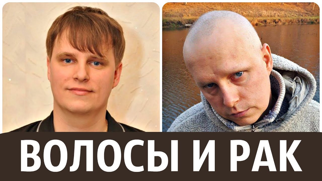 Волосы и рак. У нас лимфома Ходжкина, 3 стадия. - YouTube