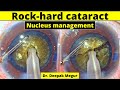 Brown rock hard cataract  nucleus management  dr deepak megur