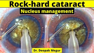 Brown rock hard cataract , Nucleus management - Dr. Deepak Megur