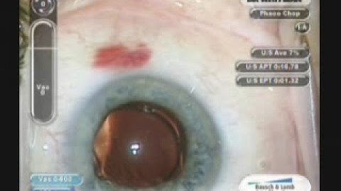 Inverting an Upside down Akreos lens implant