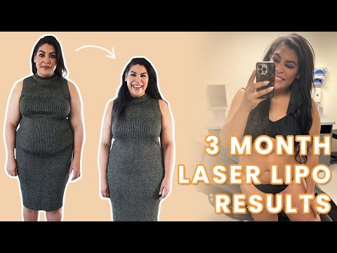 Carlene's Journey: Sono Bello Liposuction Recovery and 90 Day Body Transformation Results