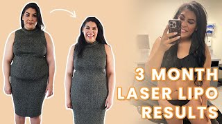 Carlene's Journey: Sono Bello Liposuction Recovery and 90 Day Body Transformation Results