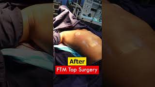 FTM Surgery cost | Keyhole FTM Top Surgery result | Top Surgery result