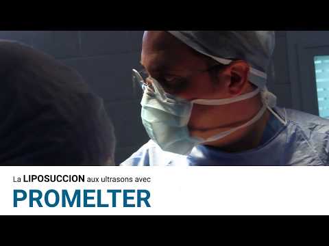 Vidéo: Liposuccion par ultrasons : caractéristiques de la procédure Ulfit