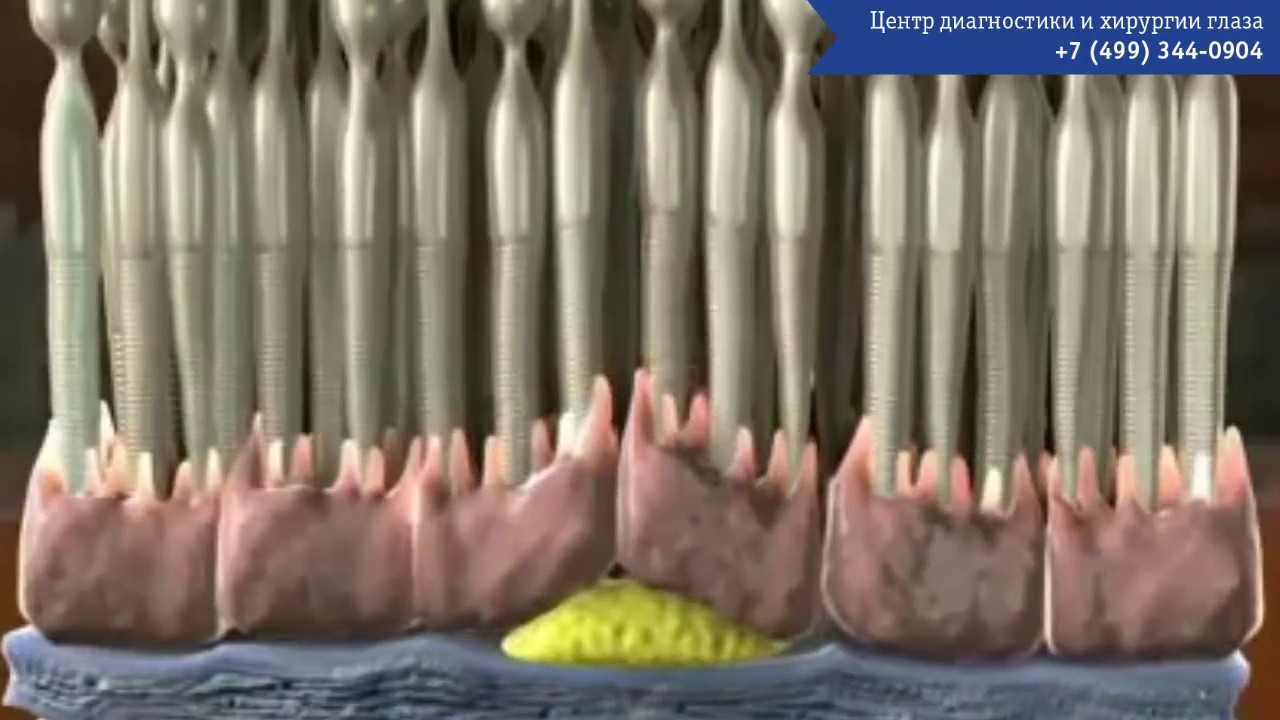 ВМД - Возрастная макулярная дегенерация сетчатки