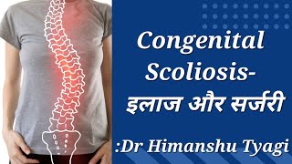 Congenital Scoliosis- इलाज और सर्जरी