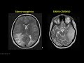 Edema cerebral