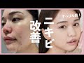 【すっぴん】ニキビ改善した方法まとめました♡ の動画、YouTube動画。