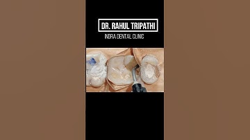 composite Restoration step by step 😀😲👍#viralshorts #shorts #composite