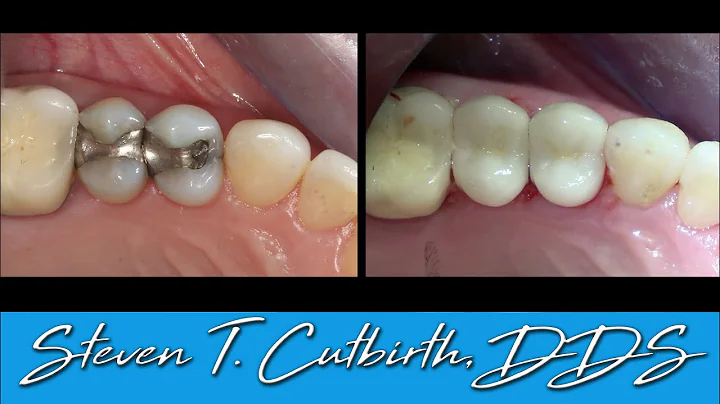 Thay thế các răng trám amalgam lớn bằng nha chu