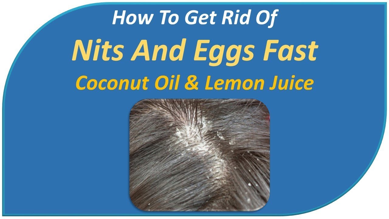 how to get rid of nits and eggs fast - Coconut Oil & Lemon Juice - YouTube
